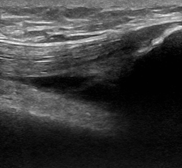 patella